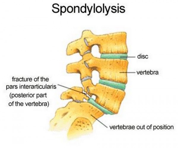 Spondylolysis - Biokineticist Andries Lodder | Bio4Me