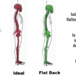 bulging-discs-posture-ideal-flat-back