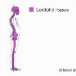 lordosis-vs-normal-alignment